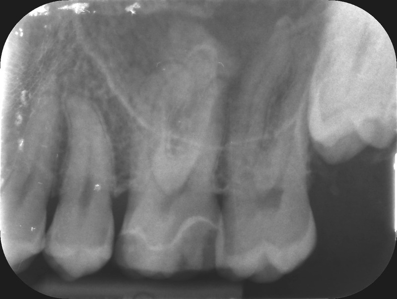 UL6 internal inflammatory resorption case image 2
